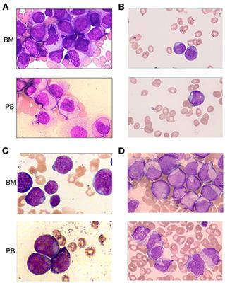 Clinical profile in KMT2A-SEPT6-positive acute myeloid leukemia: Does it often co-occur with NRAS mutations?